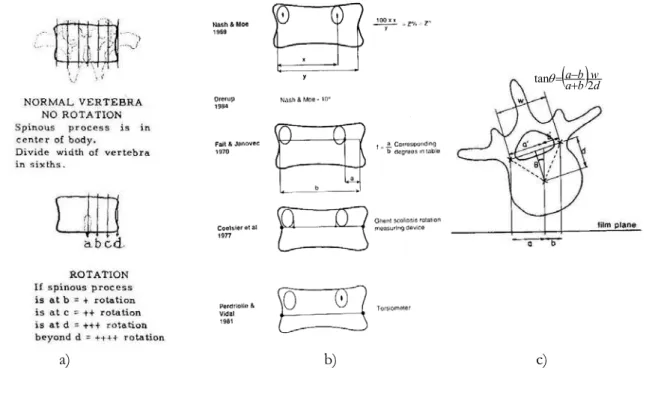 Figure 2-2 : Mesure de la rotation axiale dans la radiographie frontale  a) Méthode de Cobb (d’après Nash et Moe, 1969) 