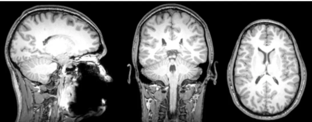 Figure 1. Séquence d’imagerie par résonance magnétique pondérée en T1 d’un cerveau humain de  jeune adulte