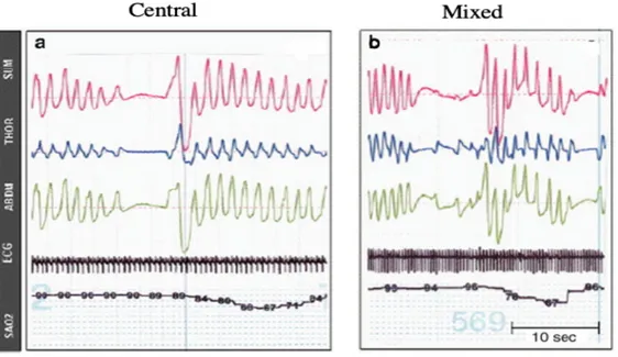 Figure 2. Two representative examples of desaturation, secondary to apnea or respiratory 