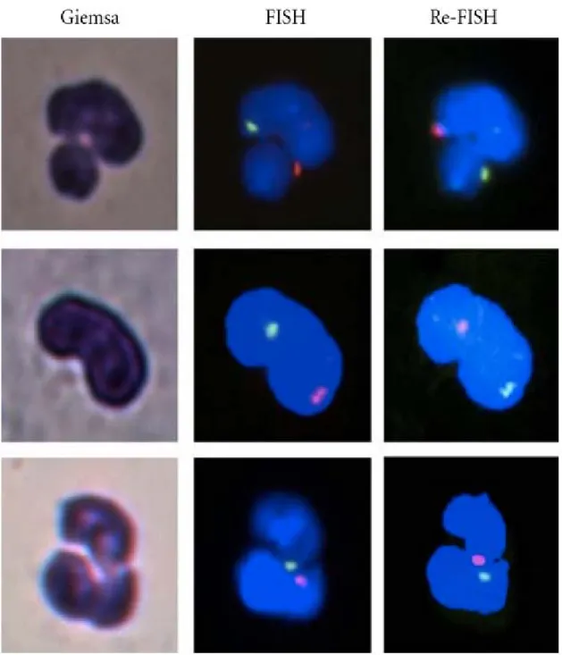 Figure 2 Example of Giemsa, FISH and re-FISH images of three detected events.  Figure demonstrates three examples of cells scored as retrieved when a captured fluorescent  image matched with a previously taken Giemsa photo