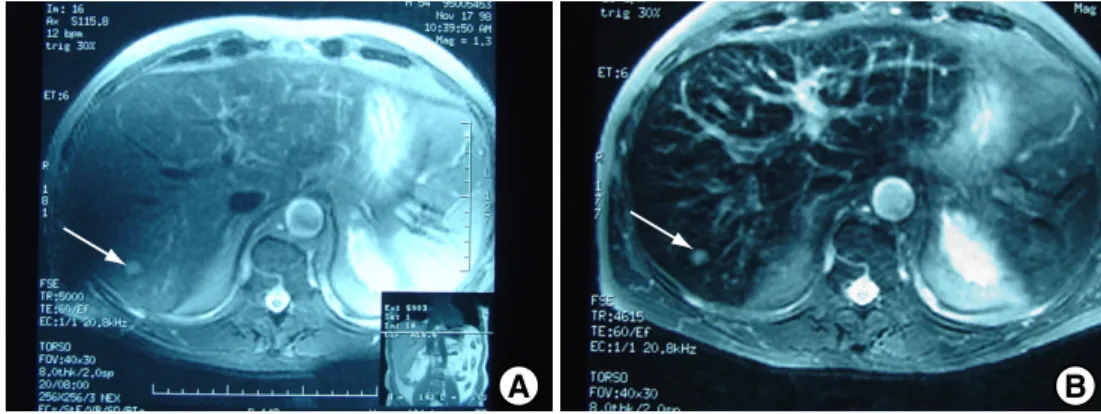 Fig. 1.6 – Clich´es d’une m´etastase (fl`eche) dans un foie. A : avant injection, B : apr`es injection intra-veineuse d’Endorem r (Laboratoire Guerbet, particules de 80 –