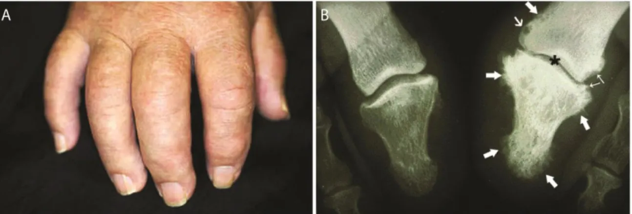 Figure 3 : Manifestations de l’arthrite psoriasique. A) Les aspects cliniques de 