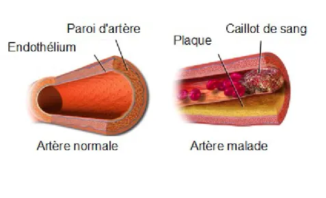 Figure 7. Illustration de la progression de la plaque d’athérome et la formation de thrombus, image modifiée  de Blausen.com staff (2014)