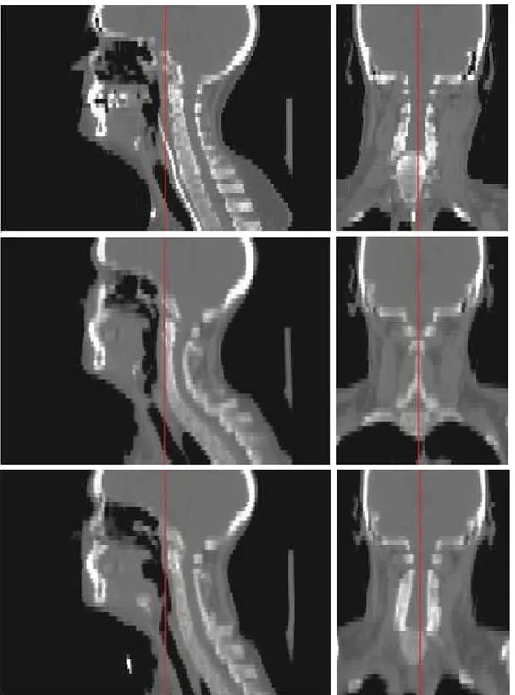 Figure 1.2: Posture correction for CT scans of head and neck with a locally ane transformation