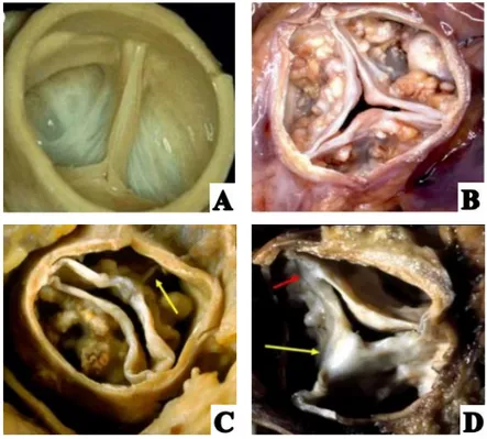 Figure 7 : Aspects de la valve aortique en fonction de l’étiologie de la sténose aortique 