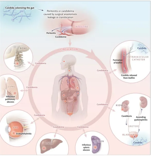 Figure 2 : Pathogenèse des candidoses invasives.  