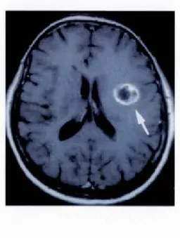 Figure  1.10  Une  coupe  axiale  du  cerveau  qui  représente  un  glioblastome  multiforme  par  résonnance magnétique  (Brat et  Mapstone ,  2003)