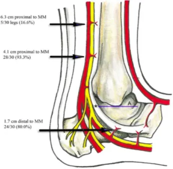 Figure 2 : Zone hypovasculaire du tendon tibial postérieur représentée par l'astérisque (*) 