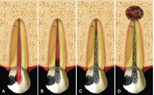 Figure 3. L’effet de la maladie carieuse sur la dent et les structures qui la supportent