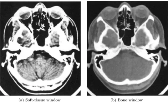 Figure 1.7 – Influence of windowing on image visualization. Case of an axial CT scan of a head ( Sartor , 2002 ).