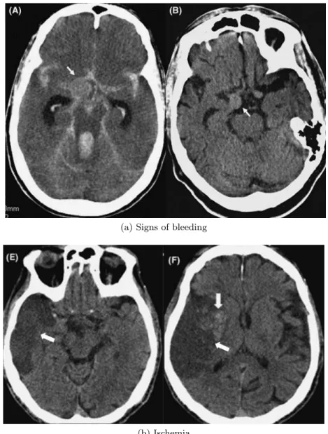 Figure 1.8 – NECT to detect signs of bleeding and ischemic stroke events ( Hurst &amp;