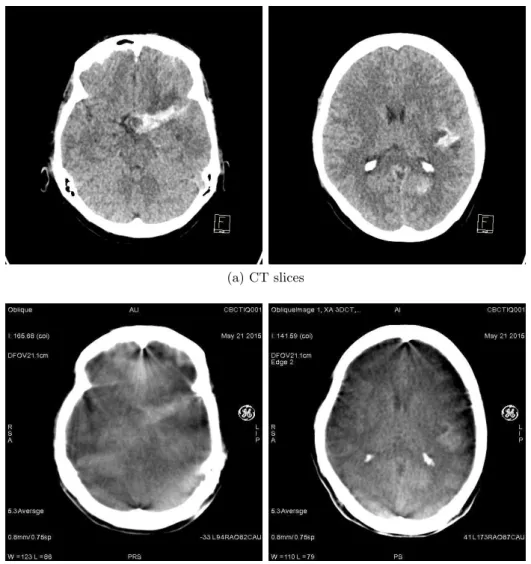 Figure 1.12 – Performance comparison between diagnostic CT images (a) and interven- interven-tional C-arm CBCT images (b) in terms of soft-tissue imaging.
