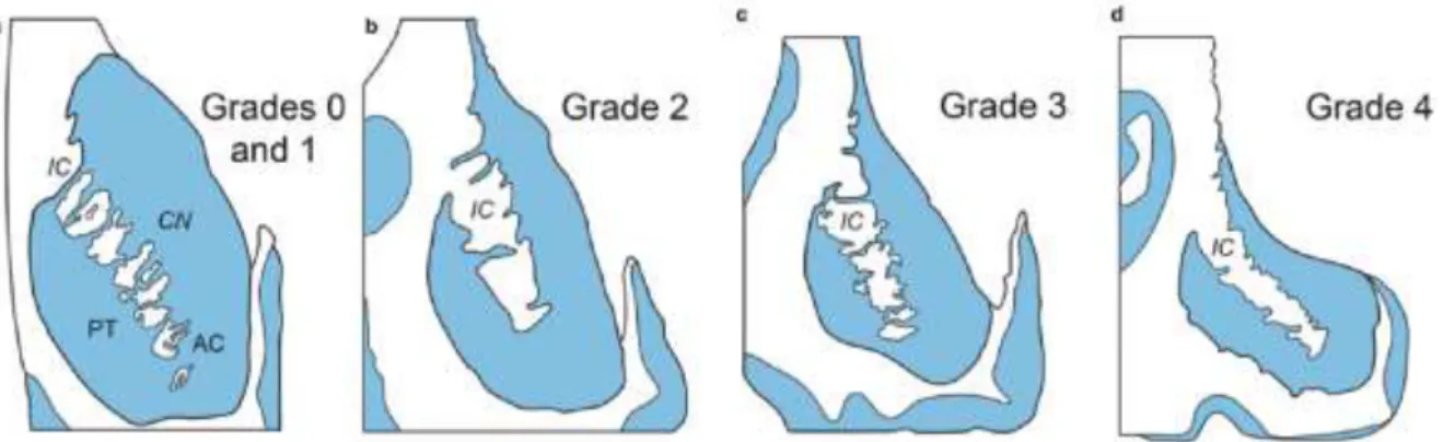 Figure 2. Progressive degeneration of the striatum in HD. (a–d) Schematized frontal sections through the rostral level of the striatum 