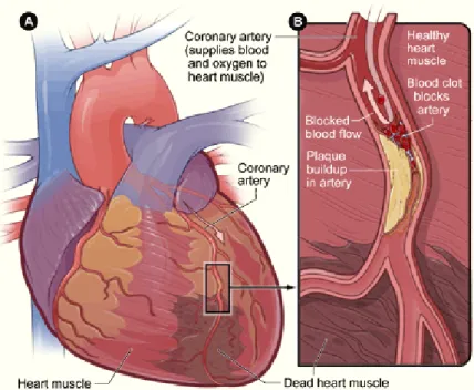 Figure 1.9 – Heart infarction caused by a blockage of a coronary artery by a blood clot [ 323 ]