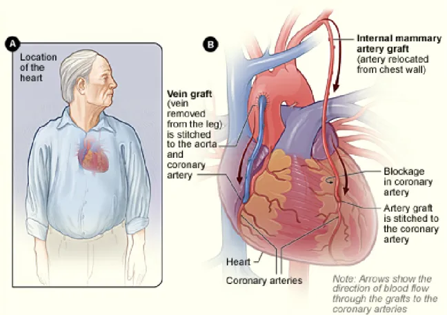 Figure 1.11 – Coronary artery Bypass Grafting: The ﬁgure shows how the vein and the artery are grafted to the heart [ 328 ].