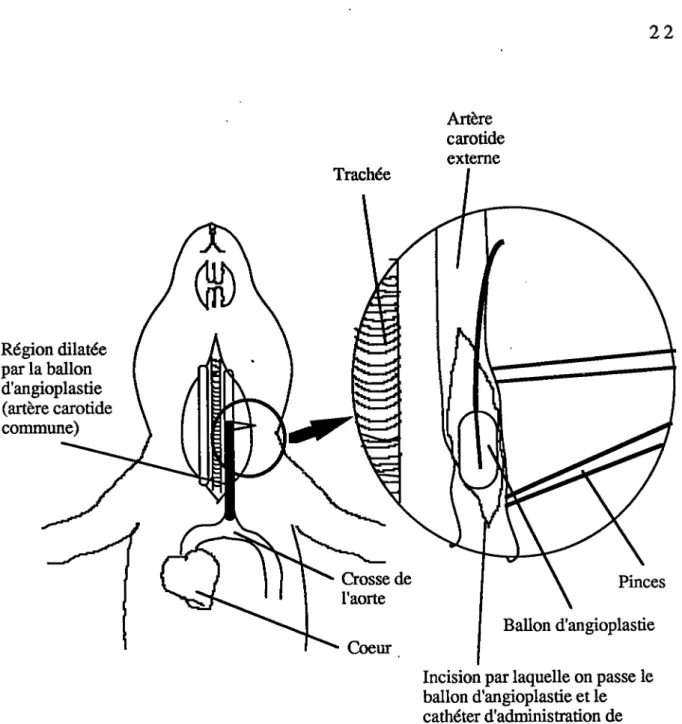 Figure 2  :  Schéma  de l'intervention. Le  ballon d'angioplastie fut introduit par une