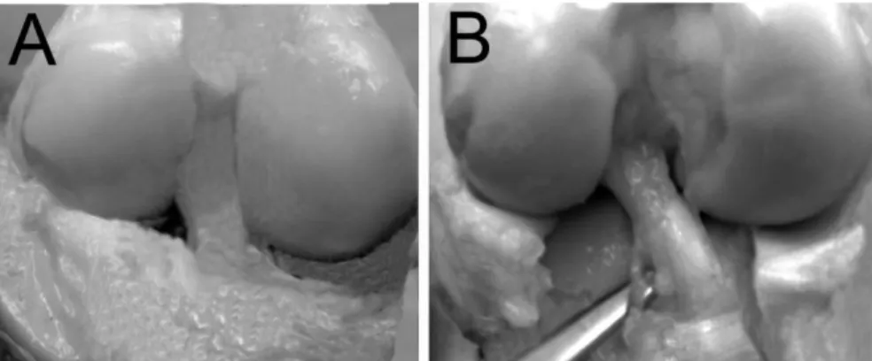 Figure 9 : Implantation d’un substitut du LCA. Vue macroscopique d'un substitut du 