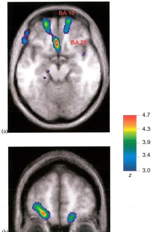Figure 9. Merged PET-MRI images illustrating CBF changes averaged for all nine subjects when the measure of total time was regressed against rCBF over the  four experimental conditions; a) the horizontal image in this figure, taken at  coordinate z = -15, 