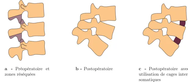 Figure 3.1 – Schéma de la technique des ostéotomies postérieurs multiples. Image d’après Aurouer et coll