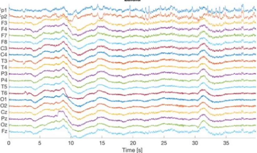 Fig. 11.4. “lalala” artefact example. The figure shows that all channels are affected starting  