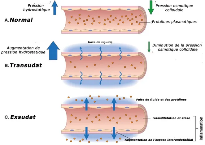 Figure 1 :  Formation du transsudat et d’exsudat (Kumar et al., 2007).