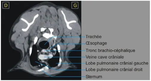 Figure 24 : Scanner thoracique au niveau de la première vertèbre thoracique   (Schevenement 2010) 