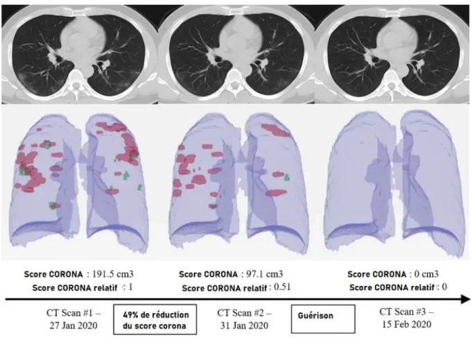 Figure 6 : Représentation de l’algorithme d’IA  RADLogics  similaire à l’IA CT Imaging Analytics 