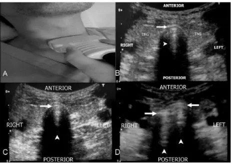 Figure 10 : Evaluation échographique selon la méthode transtrachéale statique pour déterminer la position  de la sonde endotrachéale : signe de la double ligne (Chou et al., 2011).