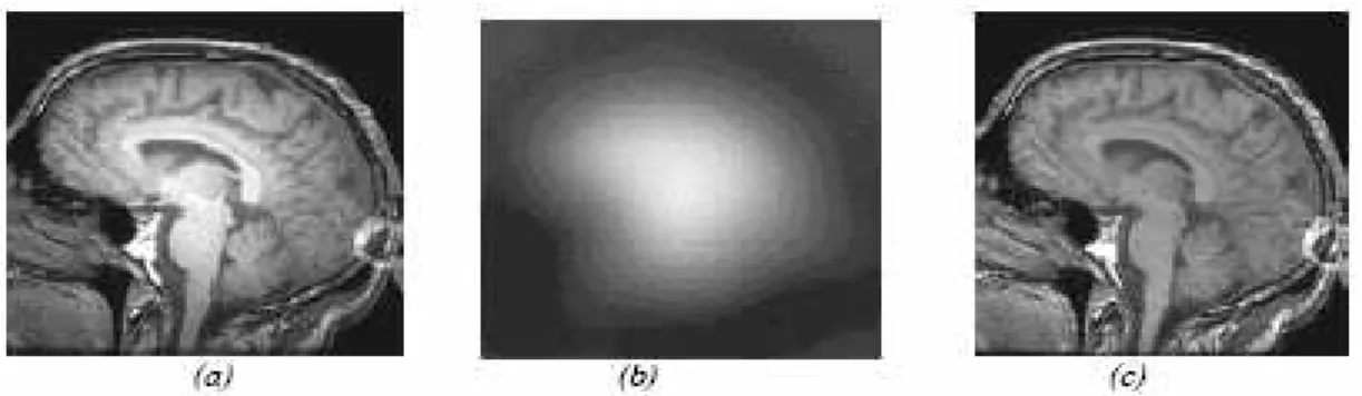Figure 1.9 : L’inhomogénéité RF. (a) : Image affectée par une inhomogénéité RF, (b) : 