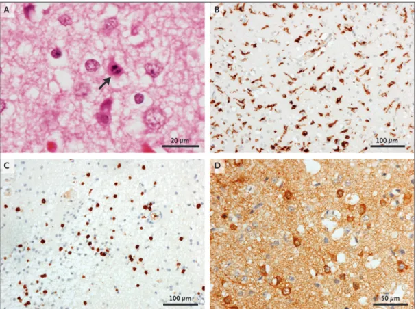 Figure 1.  Immunohistochemical Analyses of Brain Tissue from an 11-Month-Old Boy with SCID and Symptoms  of Viral Encephalitis.