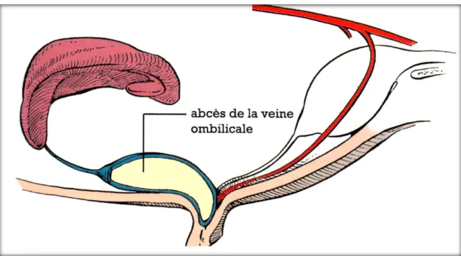 Figure 5 : Abcès de la veine ombilicale (Baxter, 1990) 