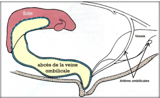 Figure 11 : Abcès de la veine ombilicale remontant jusqu'au foie (Bohy, Moissonnier, 1990) 