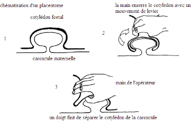 Figure 7 : Schéma de la technique de la délivrance manuelle (d’après Lhuillier, 2008) 