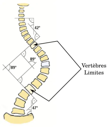 Figure 1.7 – Illustration de la mesure de l’angle de Cobb. Ici, il est de 89°. (référence de Wikipedia, source antérieure inconnue)