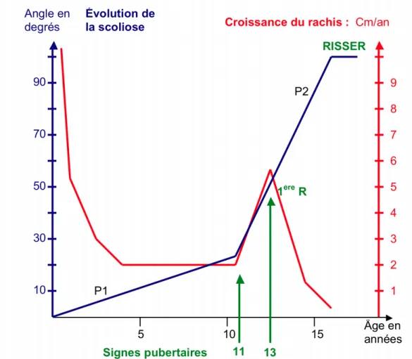 Figure 1.12 – Évolution moyenne de l’angle de Cobb d’une scoliose idiopathique en fonction de l’age du patient décrit par Duval-Beaupère (Duval-Beaupère and Lamireau (1985)).
