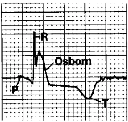 Figure 3: Onde d'Osborn sur un électrocardiogramme (d'après Hurst, 1998)