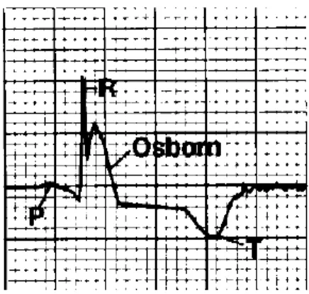 Figure 3: Onde d'Osborn sur un électrocardiogramme (d'après Hurst, 1998)