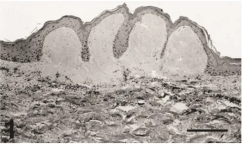Figure 11 : Aspect histologique d’une lésion de fibropapillomatose de tortue marine d'après Herbst LH et al