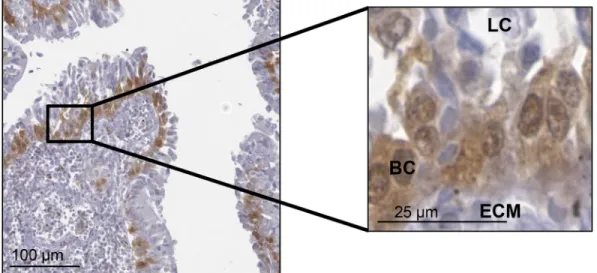 Fig 1. Gal-7 expression in prostate tissues and cancer cell lines. Immunohistochemical (IHC) staining of gal-7 in 3- μm thick sections of formalin-fixed paraffin-embedded (A) healthy prostate tissues and (B) tissues associated with pathological disorders o