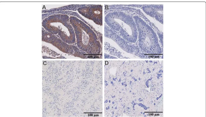Figure 3 Validation of MMP-9 antibody specificity for IHC studies. (A) Human colorectal carcinoma with intense cytoplasmic labeling of the cancer cells after incubating the section with MMP-9 primary antibody