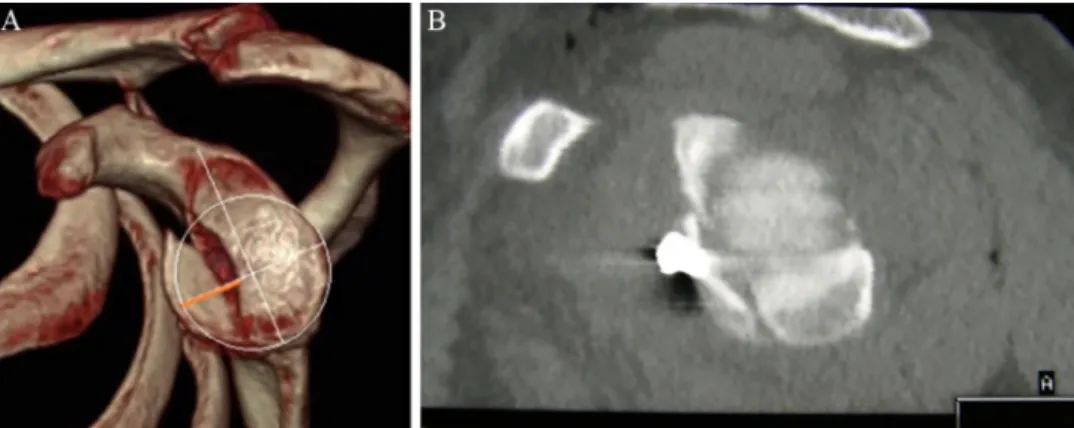 Figure 2 (A) Computed tomography with 3-dimensional reconstruction and humeral head subtraction showing an Ideberg IA glenoid frac- frac-ture in the left shoulder