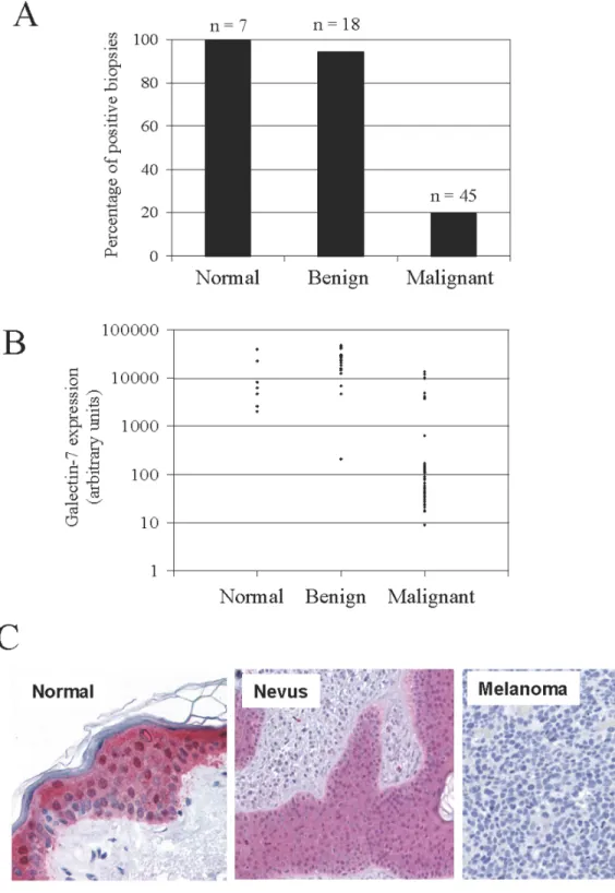 Figure 1. Galectin-7 expression in human melanoma tissues. A) Percentage of positive biopsies of normal skin (n = 7), nevus (n = 18) and malignant melanoma (n = 45), as determined by the in silico analysis of galectin-7 expression from a microarray of huma