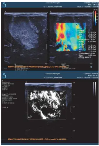 Fig. 3. Shear wave propagation induced inside the cerebral glioma by the US radiation force nonlinear effect
