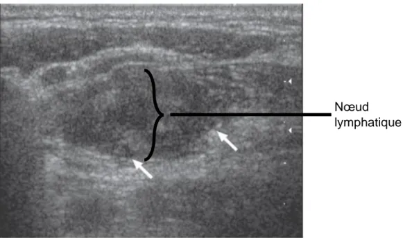 Figure 28 : Image échographique d’un nœud lymphatique chez un enfant atteint de tuberculose  (extrait de Ultrasonography of neck lymph nodes in children, (Ying et al