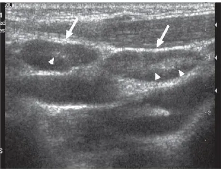 Figure 31 : Image échographique de plusieurs nœuds lymphatiques réactionnels chez un enfant de 3  ans (extrait de Ultrasonography of neck lymph nodes in children, (Ying et al