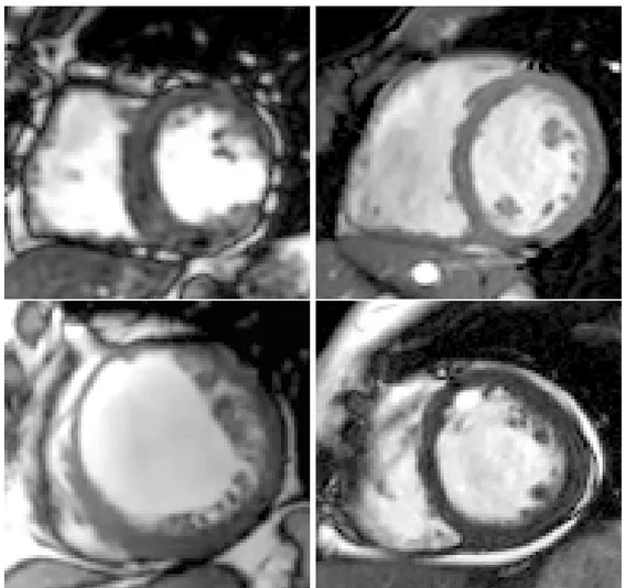 Figure 1.2: Four cardiac pathologies on MRI: heart with pericardial eﬀusion, post lateral wall myocardial infarction heart, left ventricular non-compaction and a healthy heart