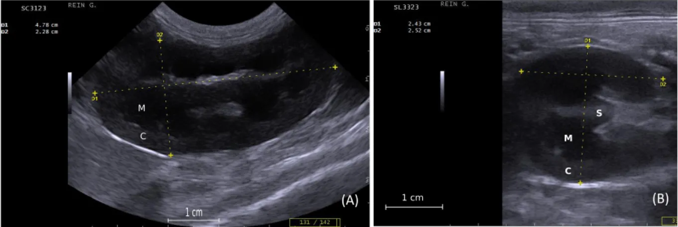 Figure 3 : Mesures échographiques des reins, réalisées en coupes sagittale et transversale