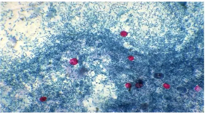Figure 10 : Oocystes de Cryptosporidium dans les selles colorés par la technique de Ziehl-Neelsen  modifiée (Gargala, 2013)  