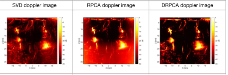 Fig. 4. The power doppler images of brain by respectively SVD, RPCA, DRPCA