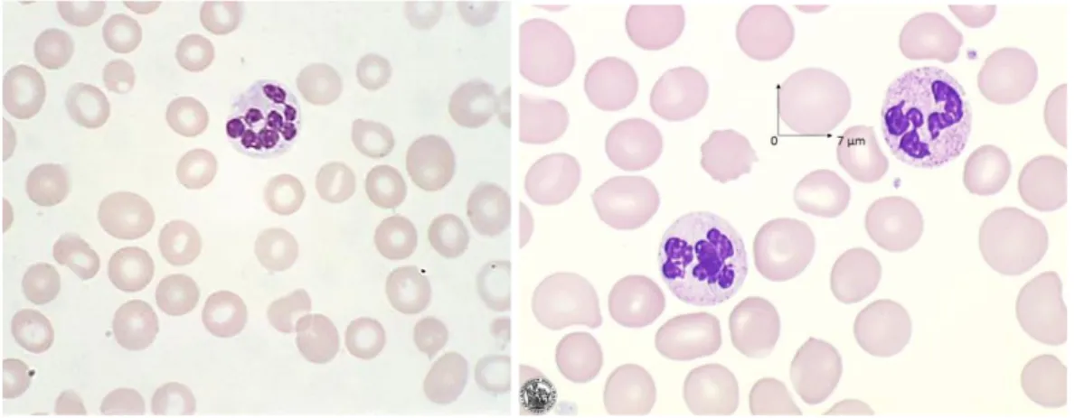 Figure  6 :  Macrocytose,  anisocytose  et  poïkilocytose  rencontrée  sur  un  frottis  de  patient  atteint  d’hypocobalaminémie